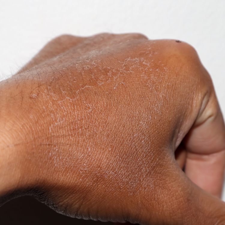 Dry Skin