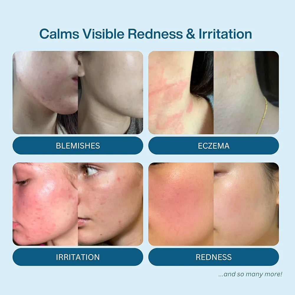 Honeydew Labs Hypochlorous Acid Spray – Dermatologist Tested HOCl Facial Cleanser for Sensitive, Acne-Prone & Irritated Skin – Soothes Redness, Eczema, Rashes & Itching