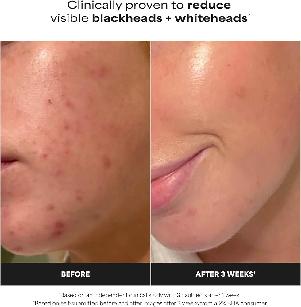 Paula’s Choice Skin Perfecting 2% BHA Exfoliant (30 ml)