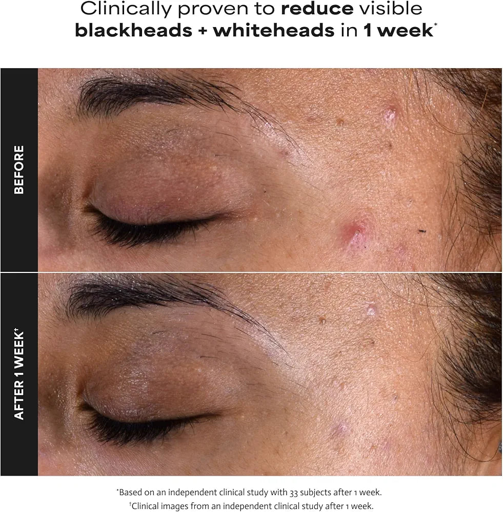 Paula’s Choice Skin Perfecting 2% BHA Exfoliant (30 ml)