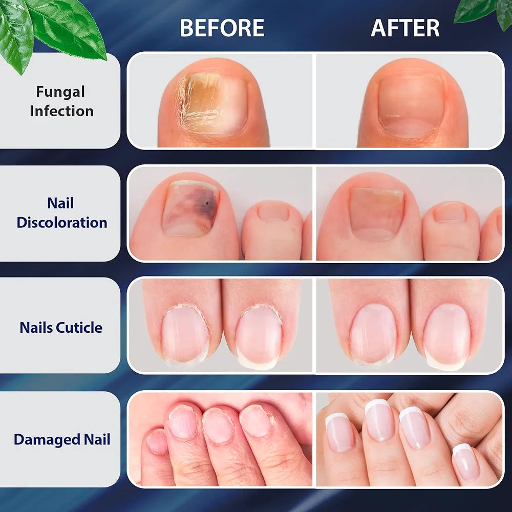 Tobcharm Toenail Fungus Treatment | Extra Strength