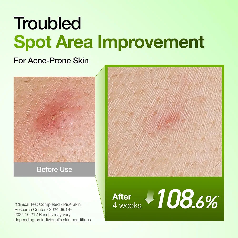 Anua Azelaic Acid 10 Hyaluron Redness Soothing Serum 30ml – Acne, Redness & Blemish Serum